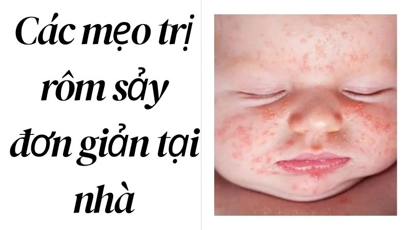 Các mẹo trị rôm sảy đơn giản tại nhà